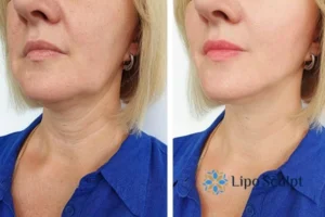 Double chin before and after Hi-Fu treatment 4 Book your double chin treatment Cambridgeshire today! We are here to help!
