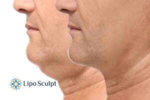 Double chin before and after Hi-Fu treatment 2 Double chin treatment Cambridgeshire from Lipo Sculpt - feel more confident today!