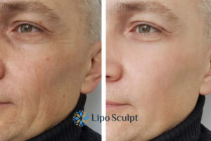 How to Fight Aging Symptoms 3 Fight Aging Symptoms Cambridgeshire With HIFU and Morpheus8 Today!