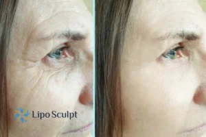 How to Fight Aging Symptoms 2 Do you want to Fight Aging Symptoms Cambridgeshire? Contact Lipo Sculpt today!