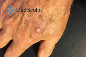 Best Actinic Keratoses Removal 2 Improve your wellbeing and health with Actinic Keratoses Cambridgeshire removal.treatment