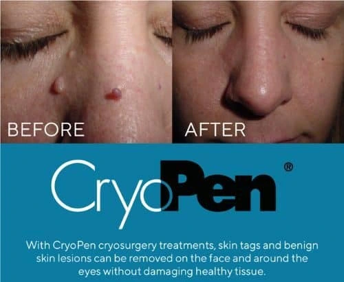 image of angiofibroma removal Cambridgeshire using Lipo Sculpt cryopen!